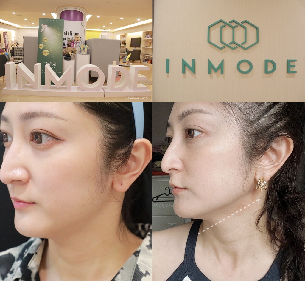 醫美|「賦真妍藍色沙龍概念店」小資女低預算也能擁有小V臉!INMODE鑽石超塑輕鬆拉回輪廓線條、拍照零死角 - 第1張圖