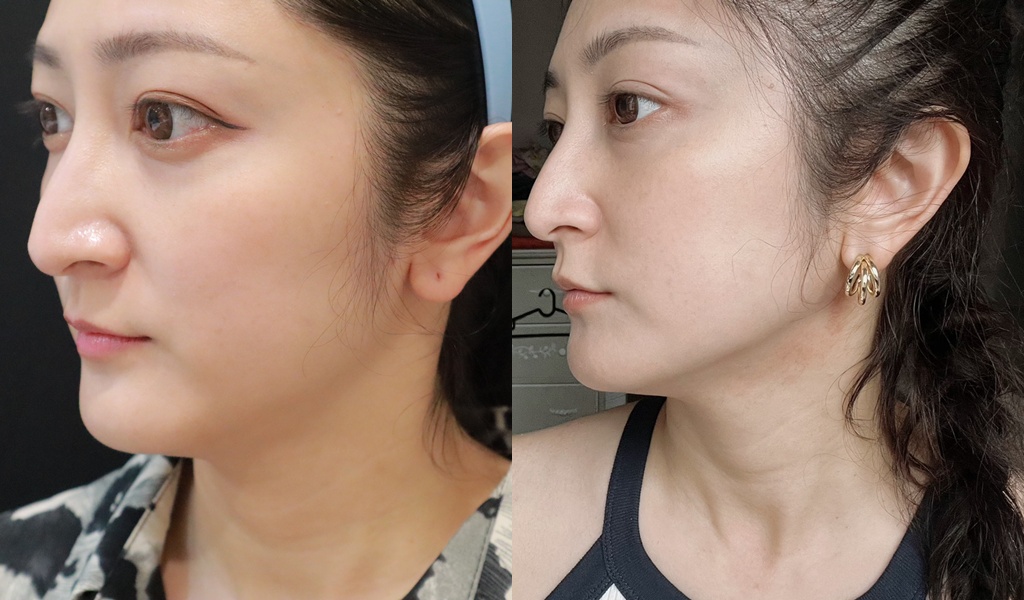 醫美|「賦真妍藍色沙龍概念店」小資女低預算也能擁有小V臉!INMODE鑽石超塑輕鬆拉回輪廓線條、拍照零死角 - 第17張圖
