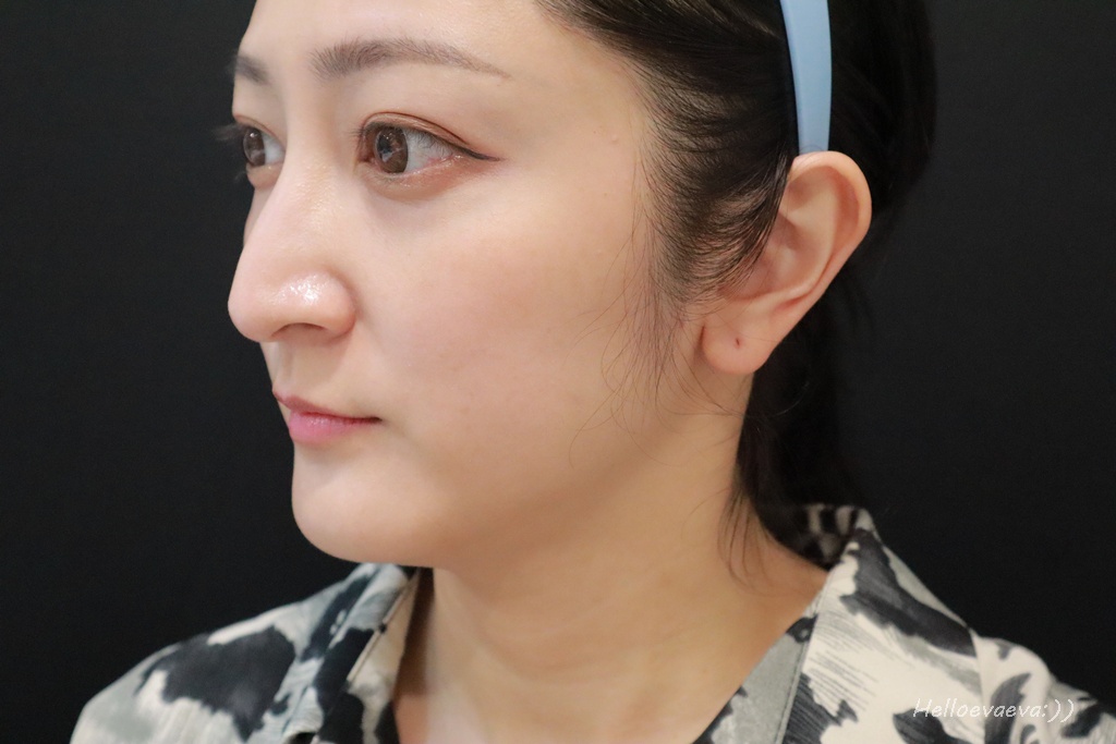 醫美|「賦真妍藍色沙龍概念店」小資女低預算也能擁有小V臉!INMODE鑽石超塑輕鬆拉回輪廓線條、拍照零死角 - 第8張圖