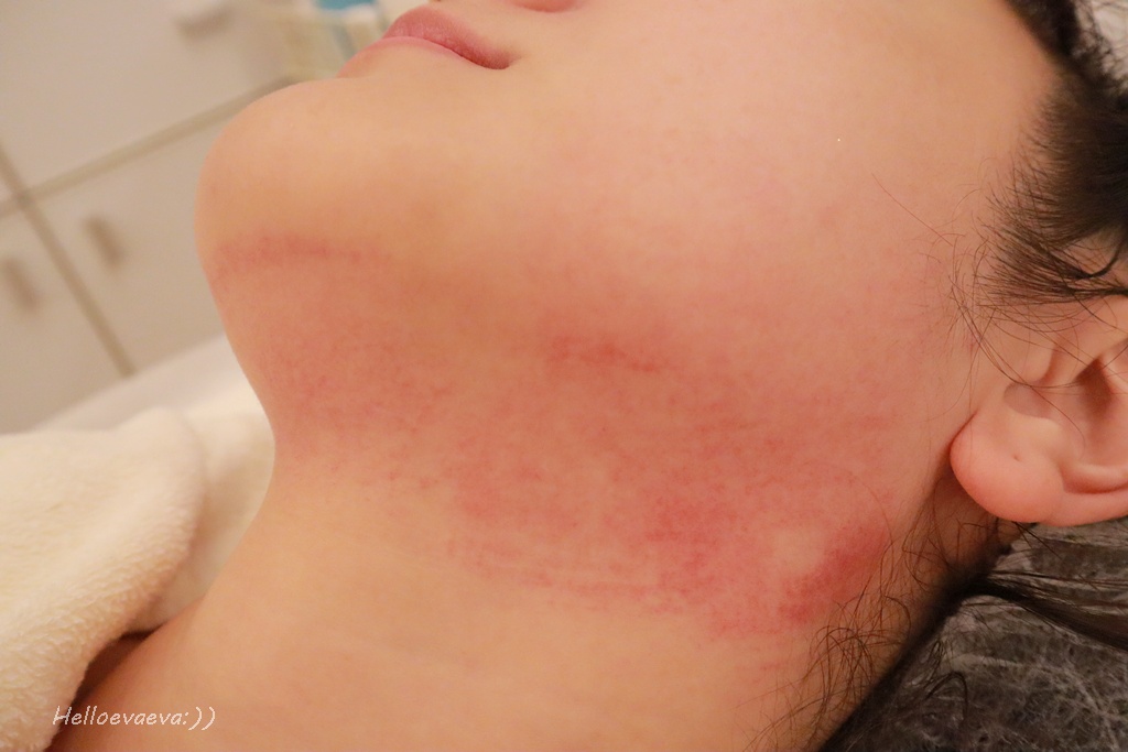 醫美|「賦真妍藍色沙龍概念店」小資女低預算也能擁有小V臉!INMODE鑽石超塑輕鬆拉回輪廓線條、拍照零死角 - 第13張圖