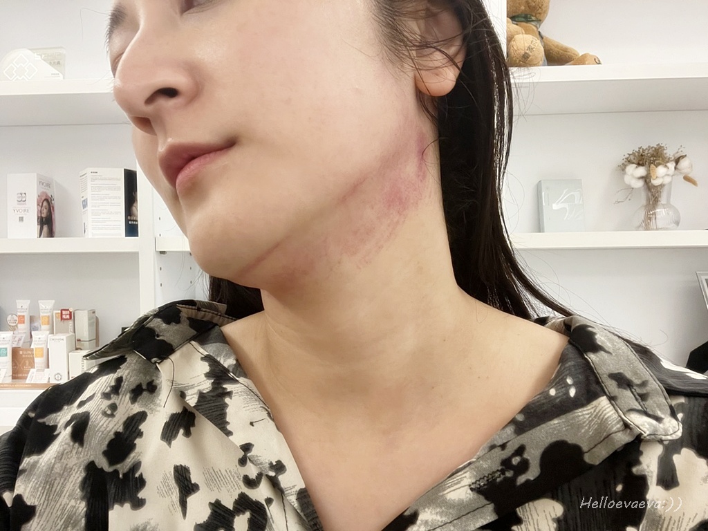 醫美|「賦真妍藍色沙龍概念店」小資女低預算也能擁有小V臉!INMODE鑽石超塑輕鬆拉回輪廓線條、拍照零死角 - 第16張圖