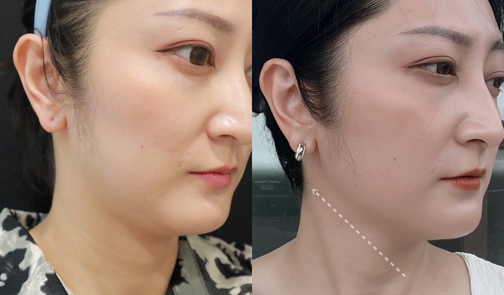 醫美|「賦真妍藍色沙龍概念店」小資女低預算也能擁有小V臉!INMODE鑽石超塑輕鬆拉回輪廓線條、拍照零死角 - 第19張圖